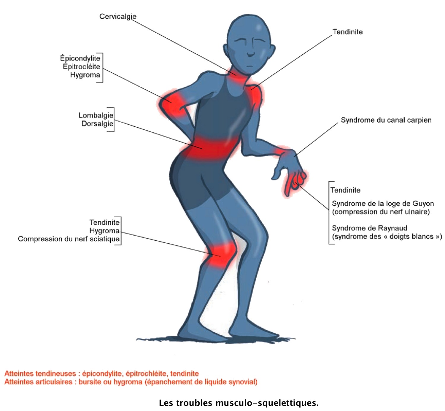 Les troubles musculo-squelettiques